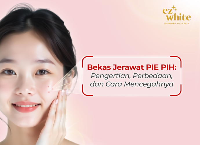 Bekas Jerawat PIE PIEH: Pengertian, Penyebab Terjadinya, dan Cara Mencegahnya