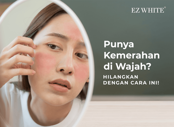 Punya Kemerahan di Wajah? Hilangkan dengan Cara Ini!